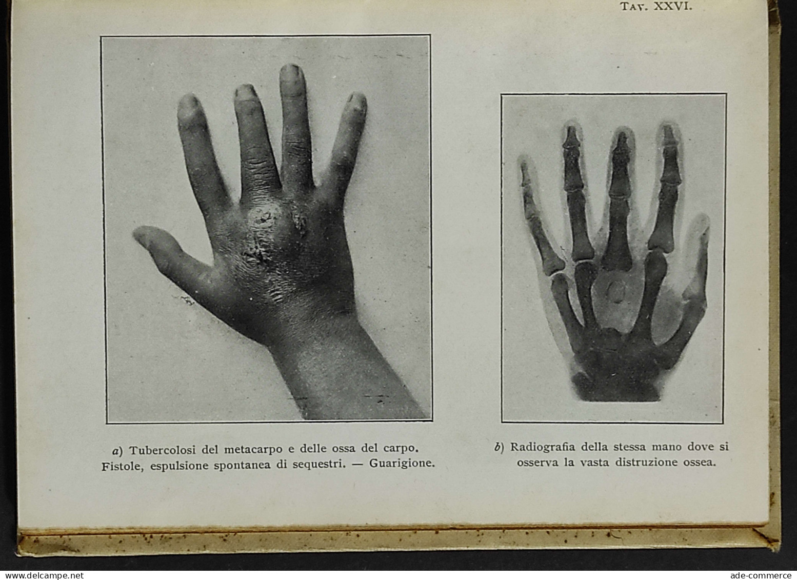 L'Elioterapia In Alta Montagna - B.-Curti - Ed. Hoepli - 1914 - Medizin, Psychologie