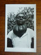 Photo Très Originale Ridax Cachet Lammeretz 852 Années 40 - GOITRE Elephantiasisme  Elephantiasis - Sin Clasificación